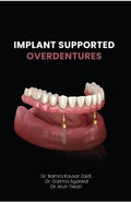 Implant Supported Overdentures