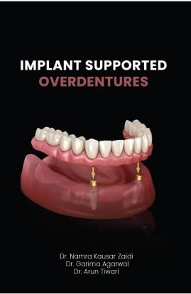 Implant Supported Overdentures