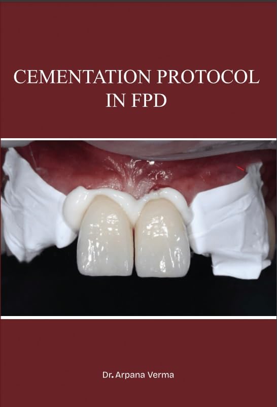 Cementation Protocol in FPD