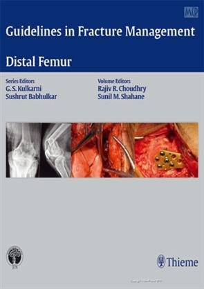 Guidelines in Fracture Management  Distal Femur
