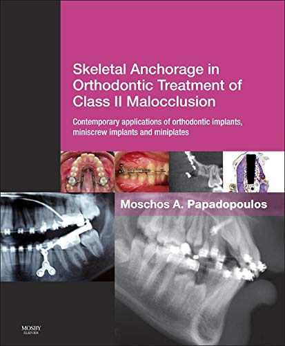 Skeletal Anchorage in Orthodontic Treatment of Class II Malocclusion: Contemporary applications of orthodontic implants, miniscr