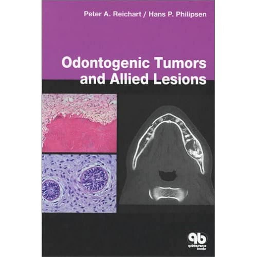 Odontogenic Tumours And Allied Lesions (Hb 2004)