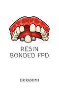 RESIN BONDED FPD