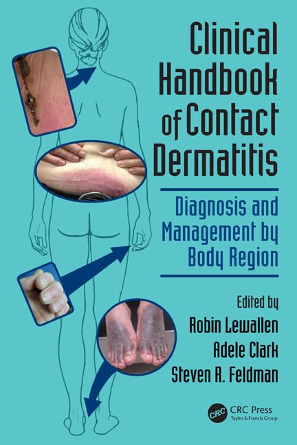 Clinical Handbook Of Contact Dermatitis (Pb 2015): Diagnosis And Management By Body Region