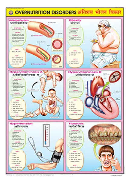 Fn09 | Teachingnest | Overnutrition Disorders Chart (70X100Cm) | Food And Nutrition Chart | Wall Sticking | English  Hindi Comb
