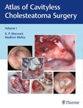 Atlas of Cavityless Cholesteatoma Surgery  Vol. 1