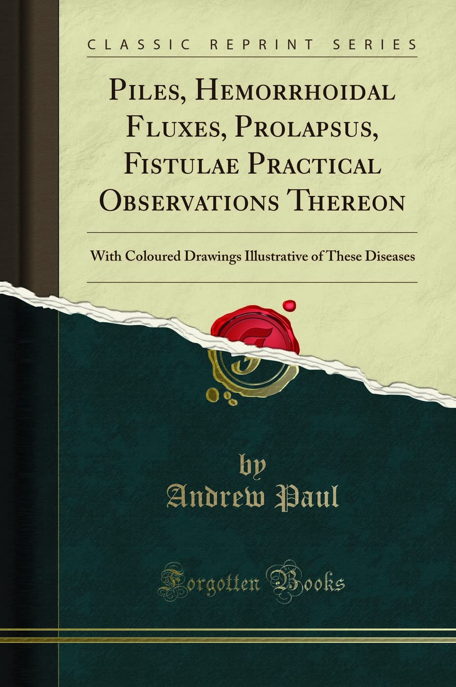 Piles, Hemorrhoidal Fluxes, Prolapsus, Fistulae Practical Observations Thereon: With Coloured Drawings Illustrative of These Dis