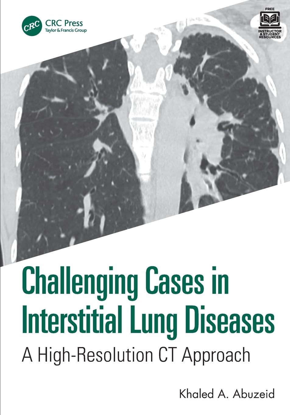 Challenging Cases in Interstitial Lung Diseases: A Highresolution Ct Approach