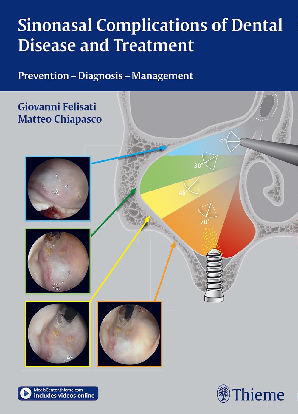 Sinonasal Complications of Dental Disease and Treatment: Prevention  Diagnosis  Management