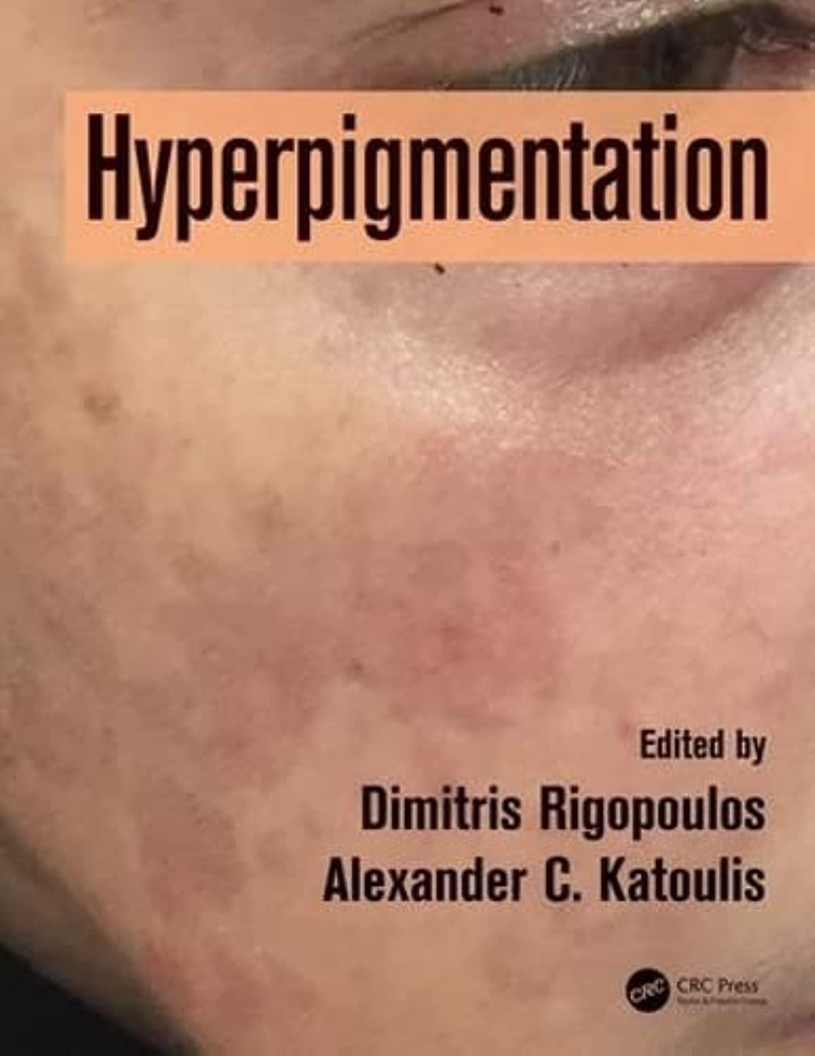 Hyperpigmentation (Hb 2018)
