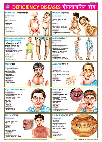 FN08 | TeachingNest | Deficiency Diseases Chart (70x100cm) | Food and Nutrition Chart | Wall Sticking | English  Hindi Combined