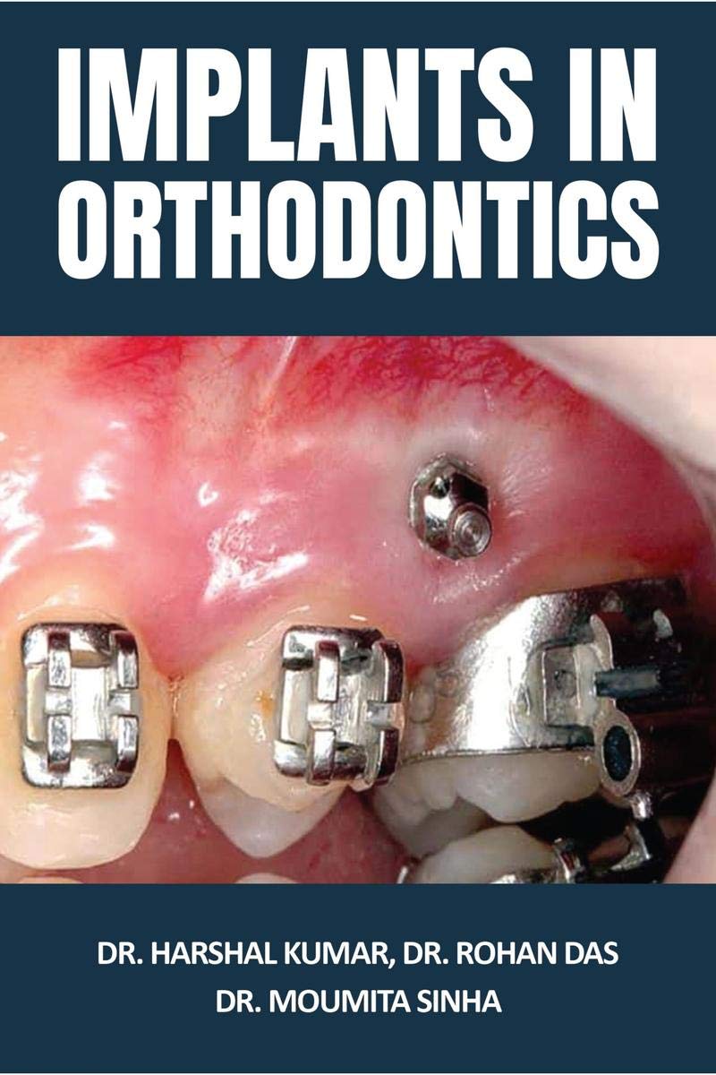 Implants In Orthodontics