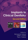 Implants In Clinical Dentistry: 2