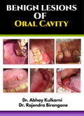 Benign Lesions of Oral Cavity