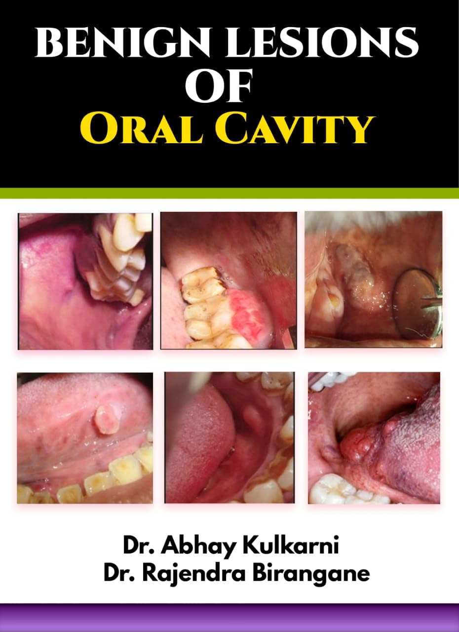 Benign Lesions of Oral Cavity