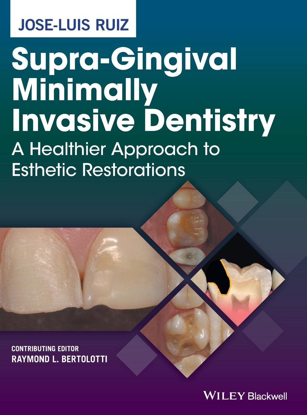 SupraGingival Minimally Invasive Dentistry: A Healthier Approach to Esthetic Restorations