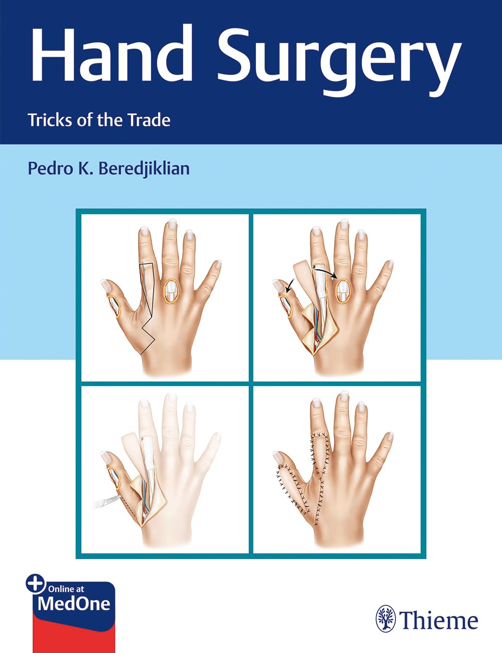 HAND SURGERY TRICKS OF THE TRADE WITH ACCESS CODE (HB 2020)