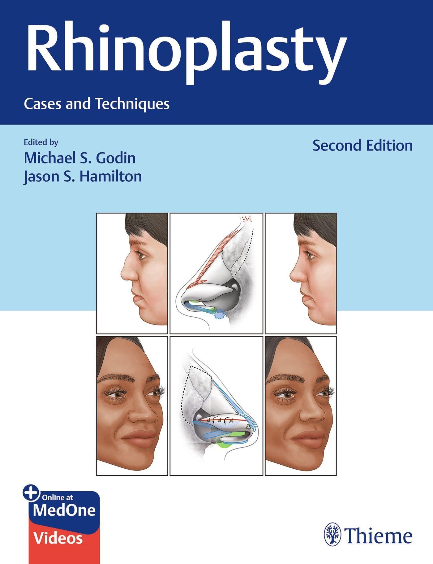 RHINOPLASTY CASES AND TECHNIQUES WITH ACCESS CODE 2ED (HB 2025