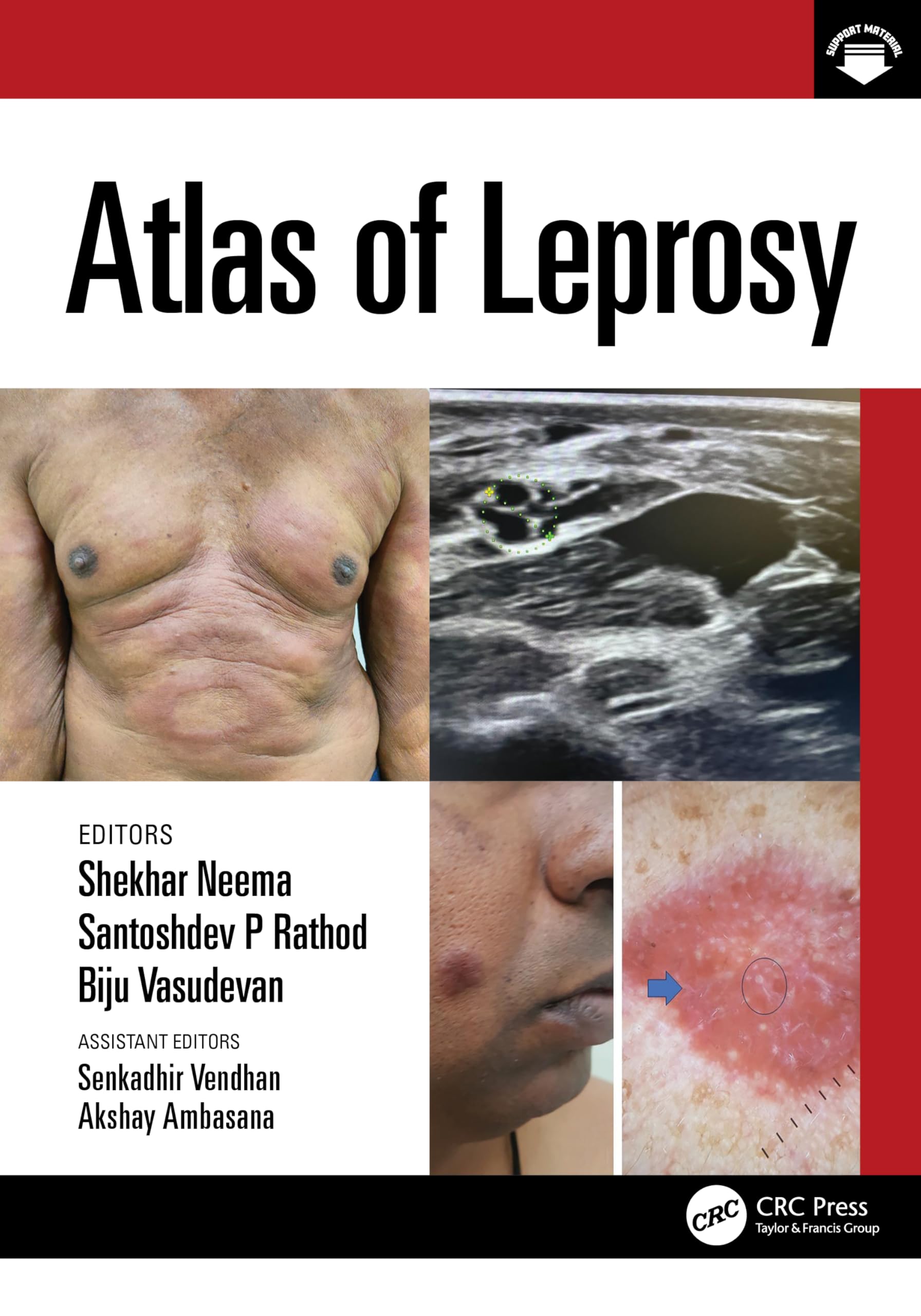 Atlas Of Leprosy (Pb 2025)