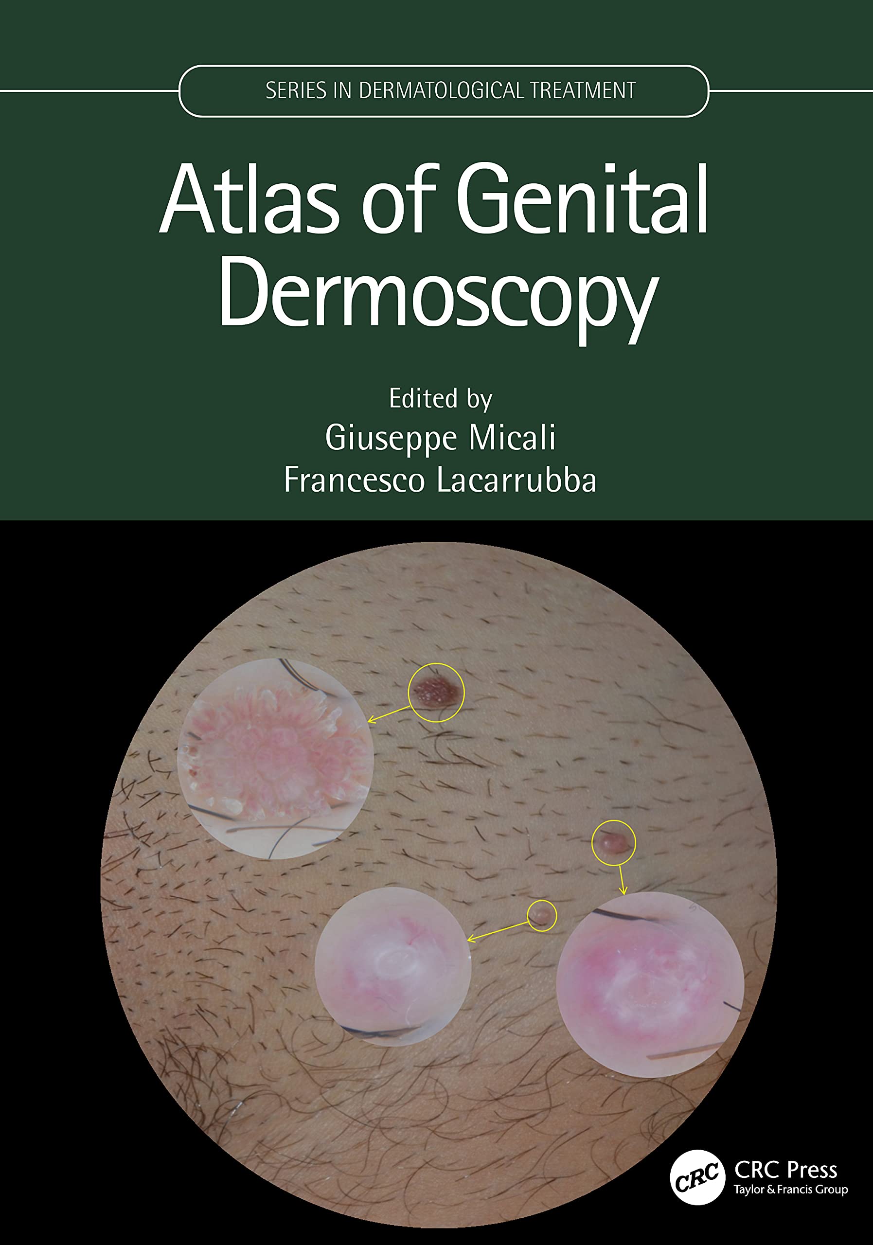 ATLAS OF GENITAL DERMOSCOPY (HB 2022) (Series in Dermatological Treatment)