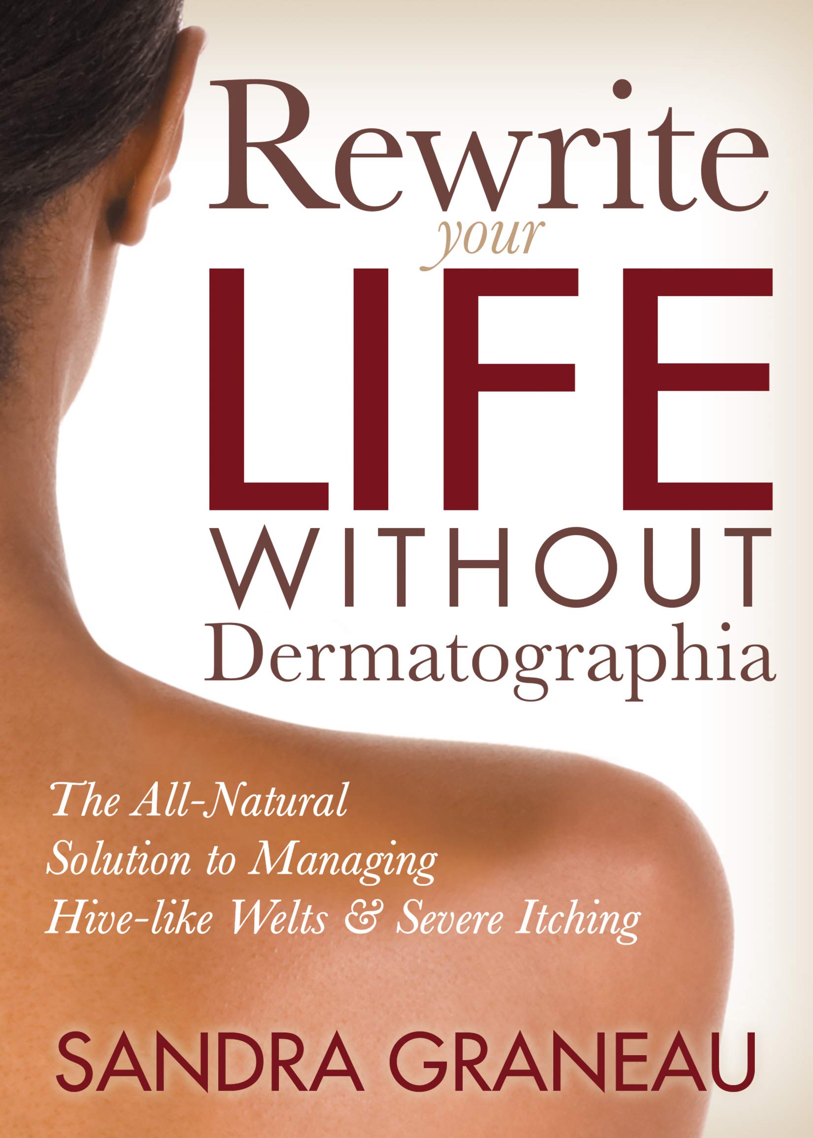 Rewrite Your Life Without Dermatographia: The AllNatural Solution to Managing Hivelike Welts and Severe Itching