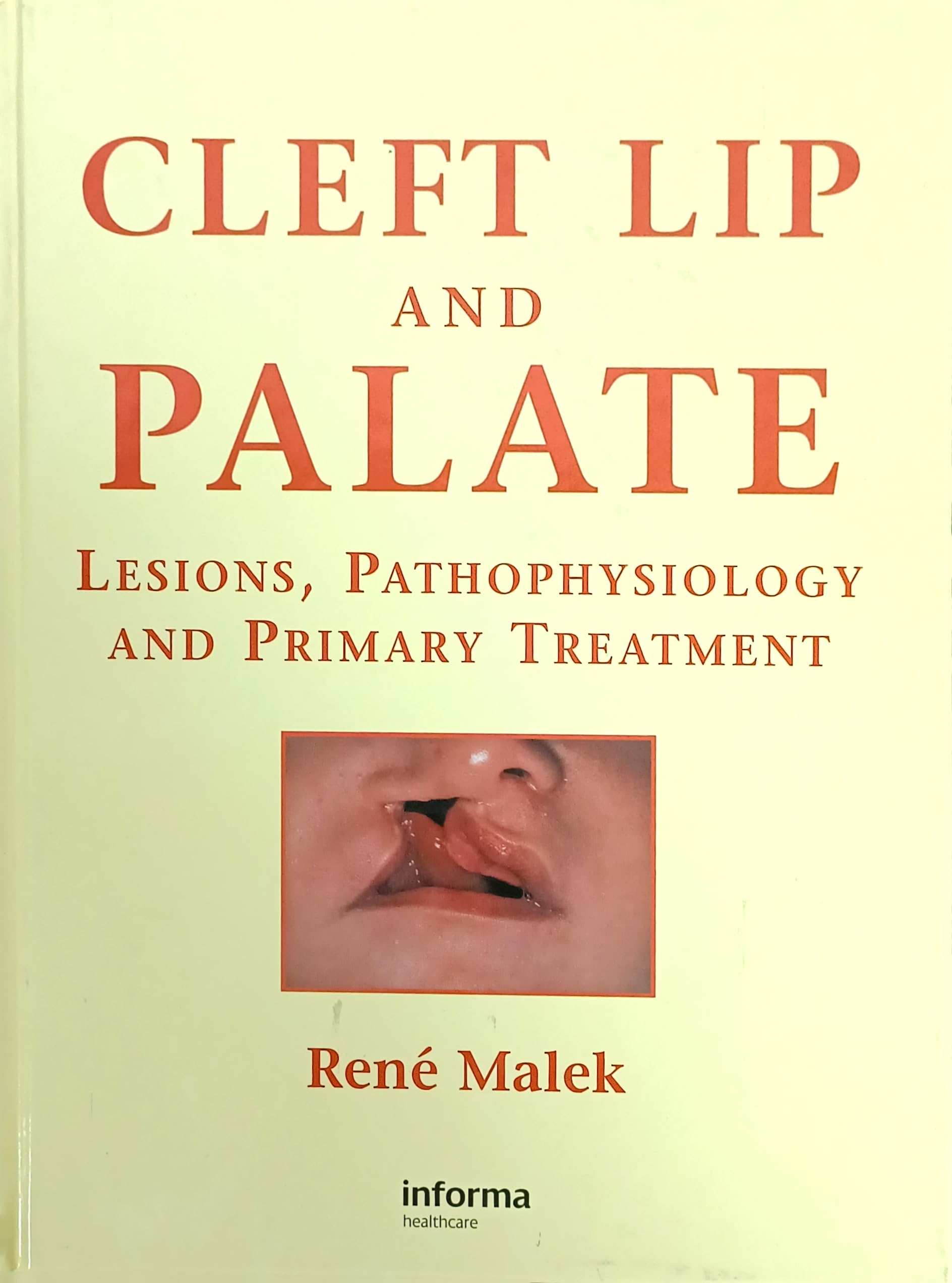 Cleft Lip And Palate Lesions Pathophysiology And Primary Treatment (Hb 2008)
