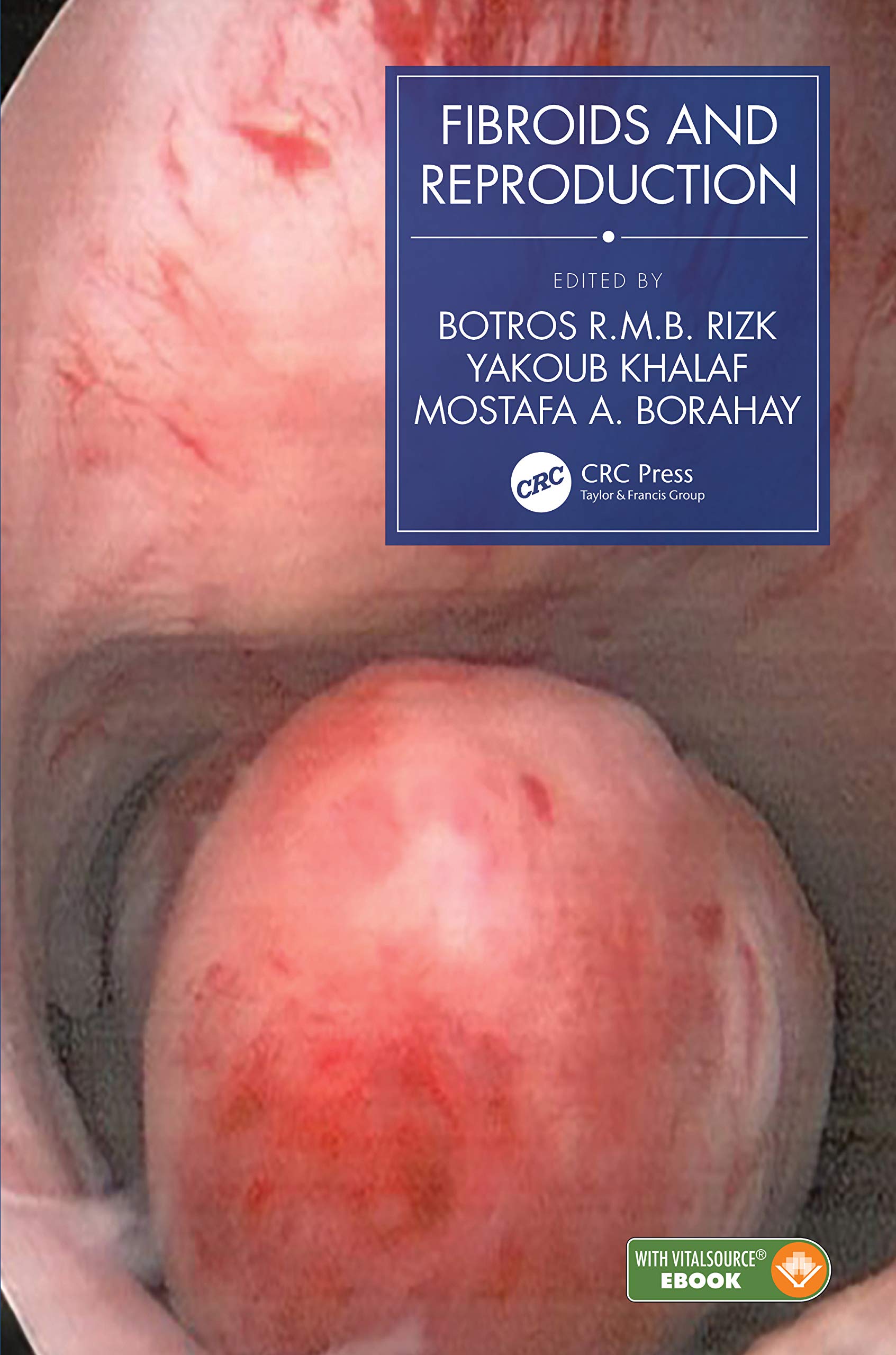 Fibroids And Reproduction (Hb 2021)