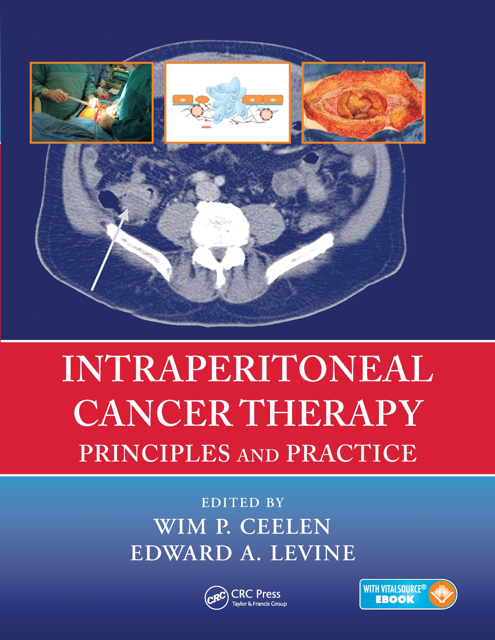 Intraperitoneal Cancer Therapy Principles And Practice (Pb 2020)