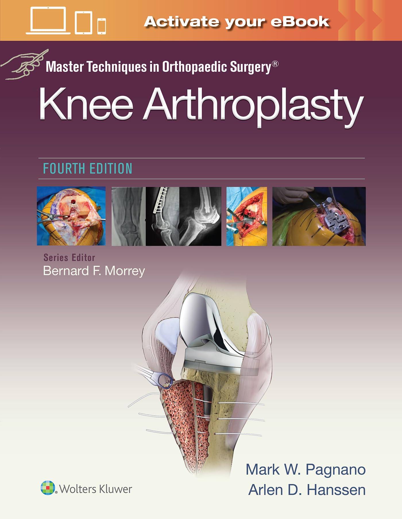 Master Techniques in Orthopedic Surgery: Knee Arthroplasty (Master Techniques in Orthopaedic Surgery)