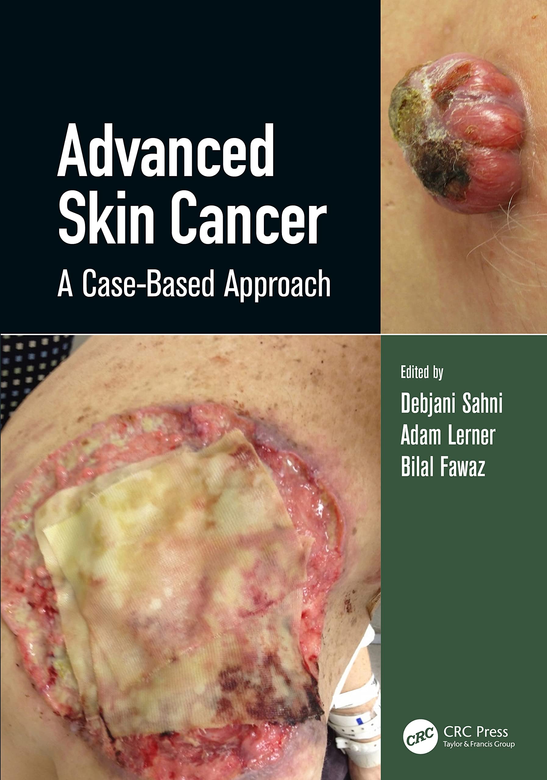 ADVANCED SKIN CANCER A CASE BASED APPROACH (HB 2022)