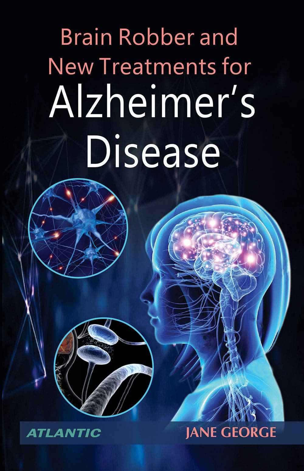 Brain Robber And New Treatments For Alzheimers Disease