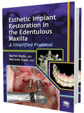 Esthetic Implant Restoration In The Edentulous Maxilla: A Simplified Protocol