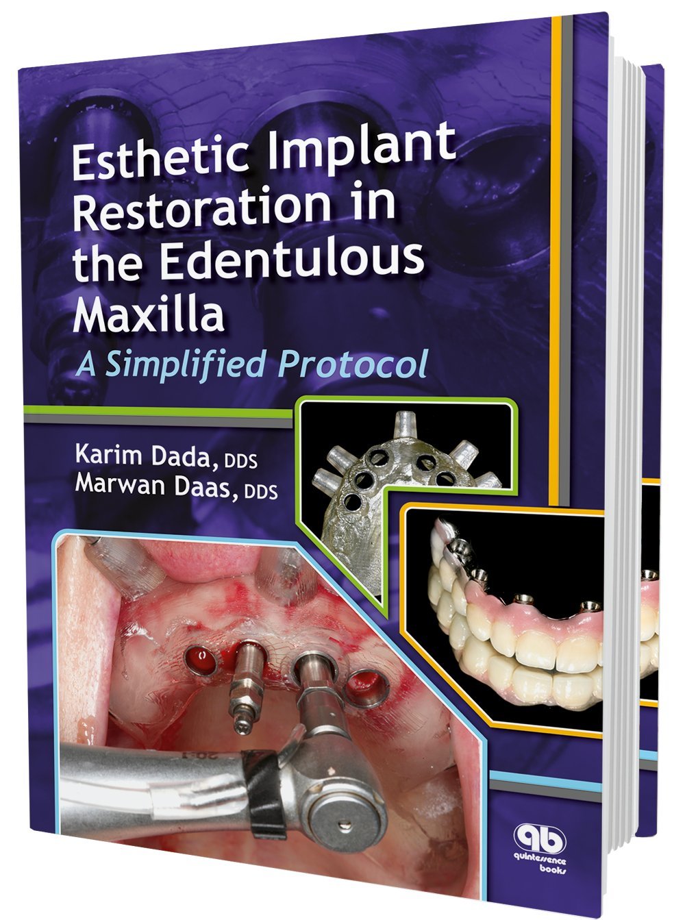 Esthetic Implant Restoration In The Edentulous Maxilla: A Simplified Protocol