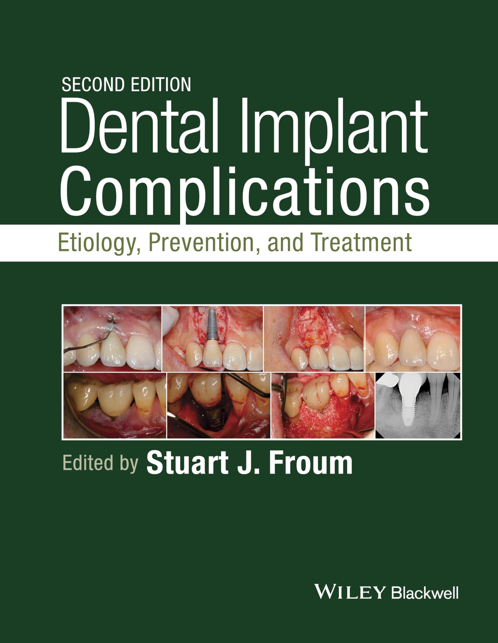 Dental Implant Complications: Etiology, Prevention, and Treatment