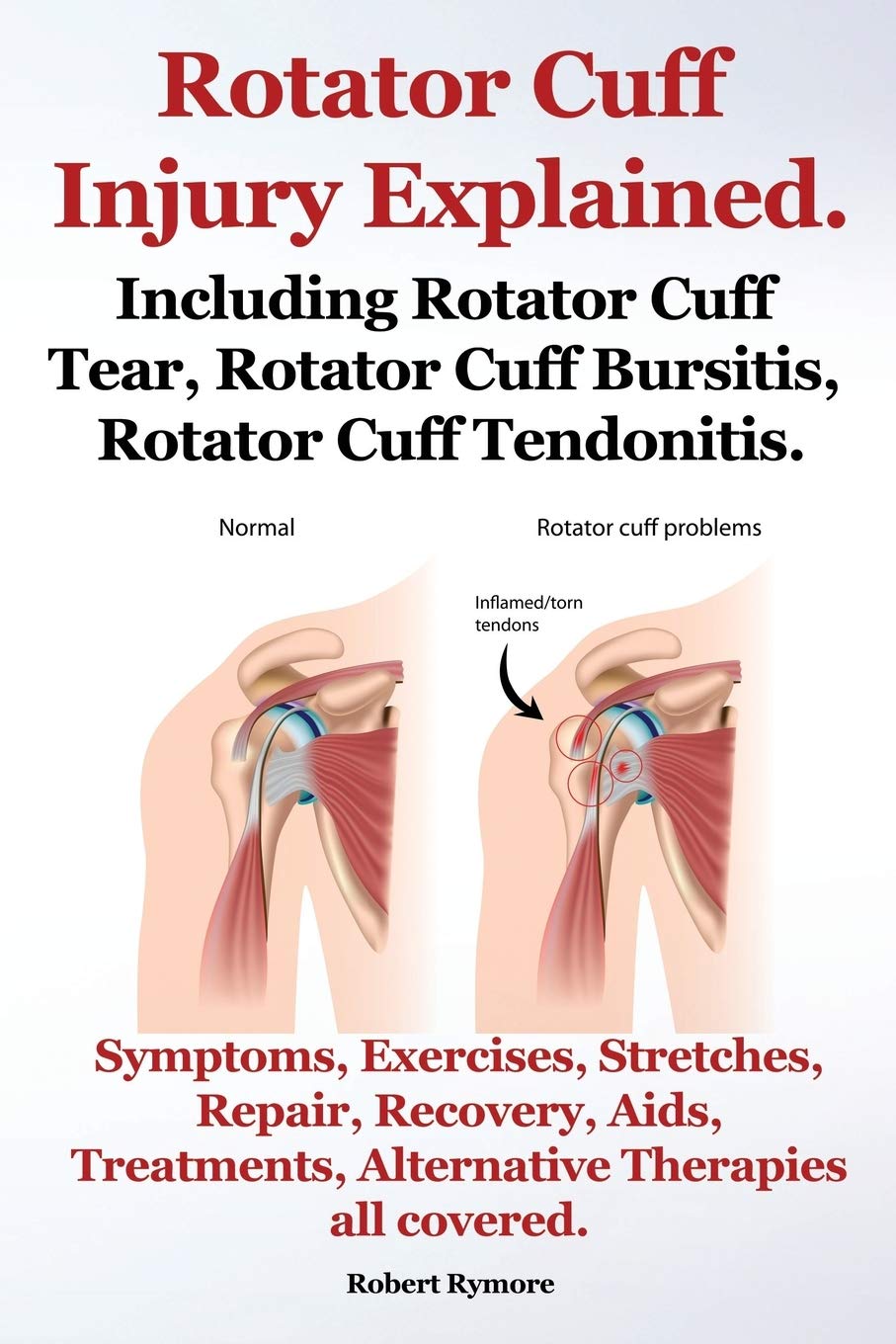 Rotator Cuff Injury Explained. Including Rotator Cuff Tear, Rotator Cuff Bursitis, Rotator Cuff Tendonitis. Symptoms, Exercises,