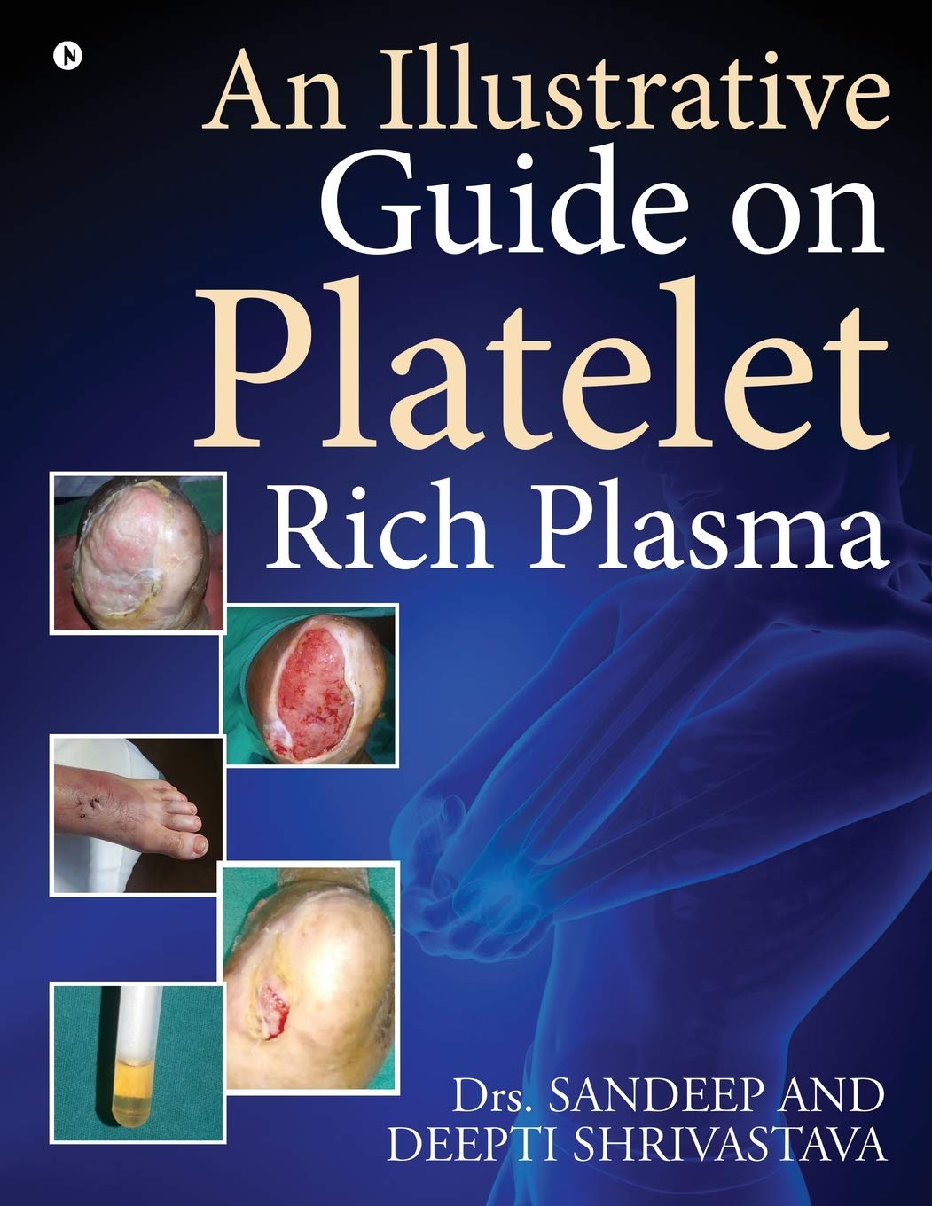 An Illustrative Guide On Platelet Rich Plasma