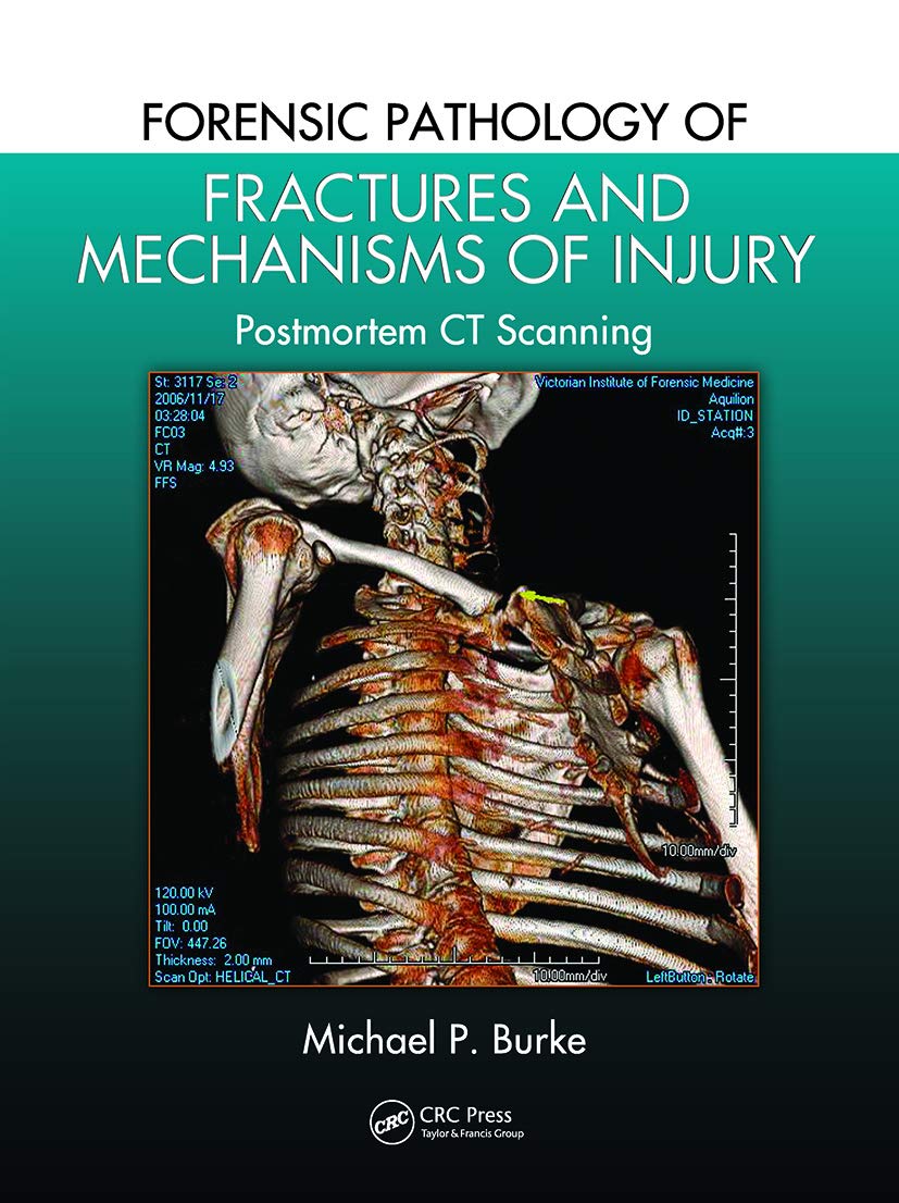 Forensic Pathology Of Fractures And Mechanisms Of Injury Postmortem Ct Scanning (Pb 2021)