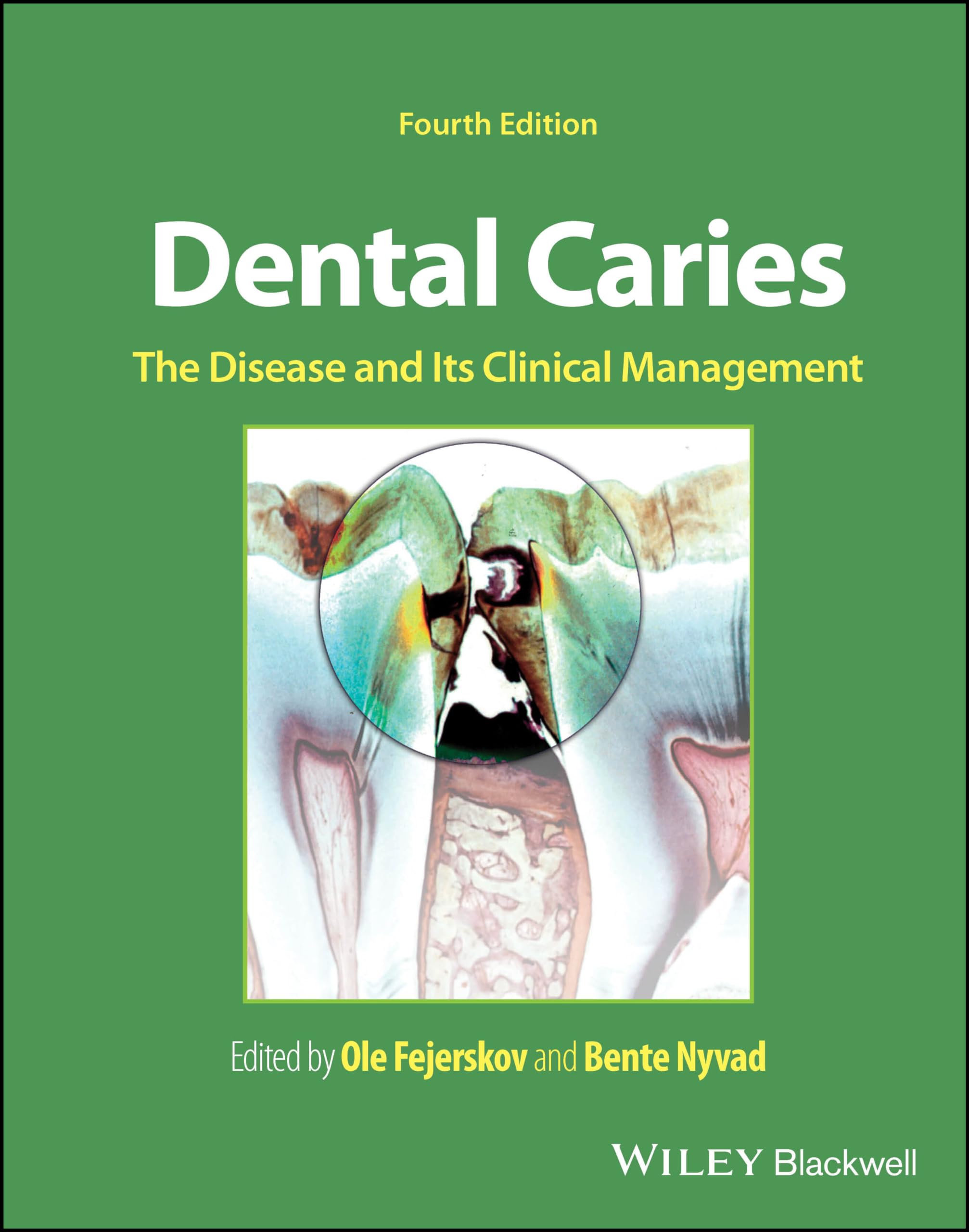Dental Caries: The Disease and Its Clinical Management