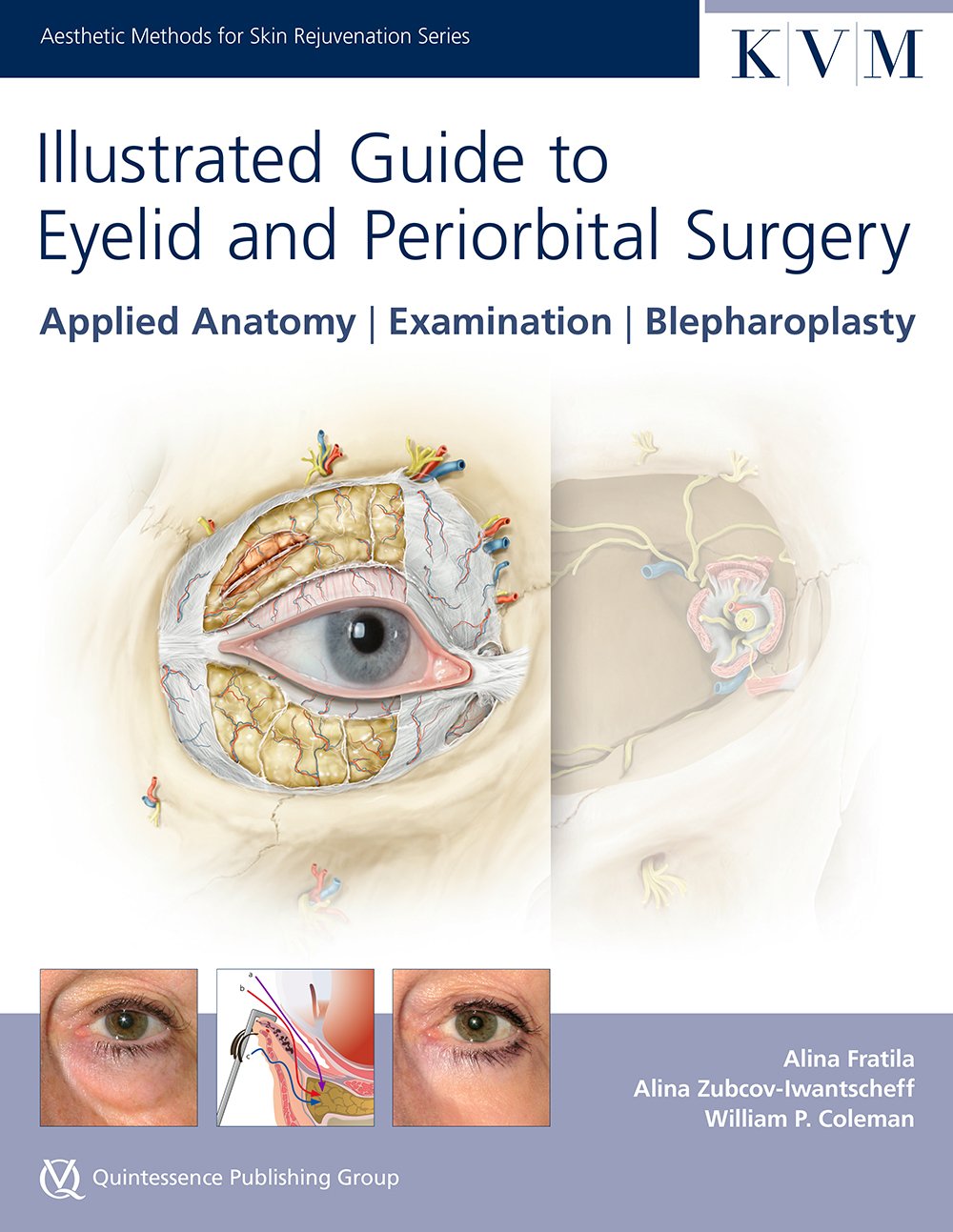 ILLUSTRATED GUIDE TO EYELID AND PERIORBITAL SURGERY APPLIED ANATOMY EXAMINATION BLEPHAROPLASTY (HB 2015) (Aesthetic Methods for 