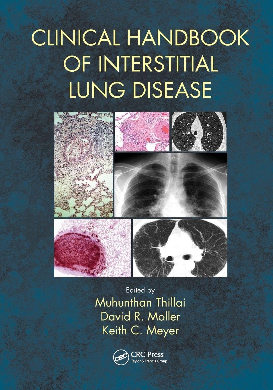 Clinical Handbook Of Interstitial Lung Disease (Pb 2018)