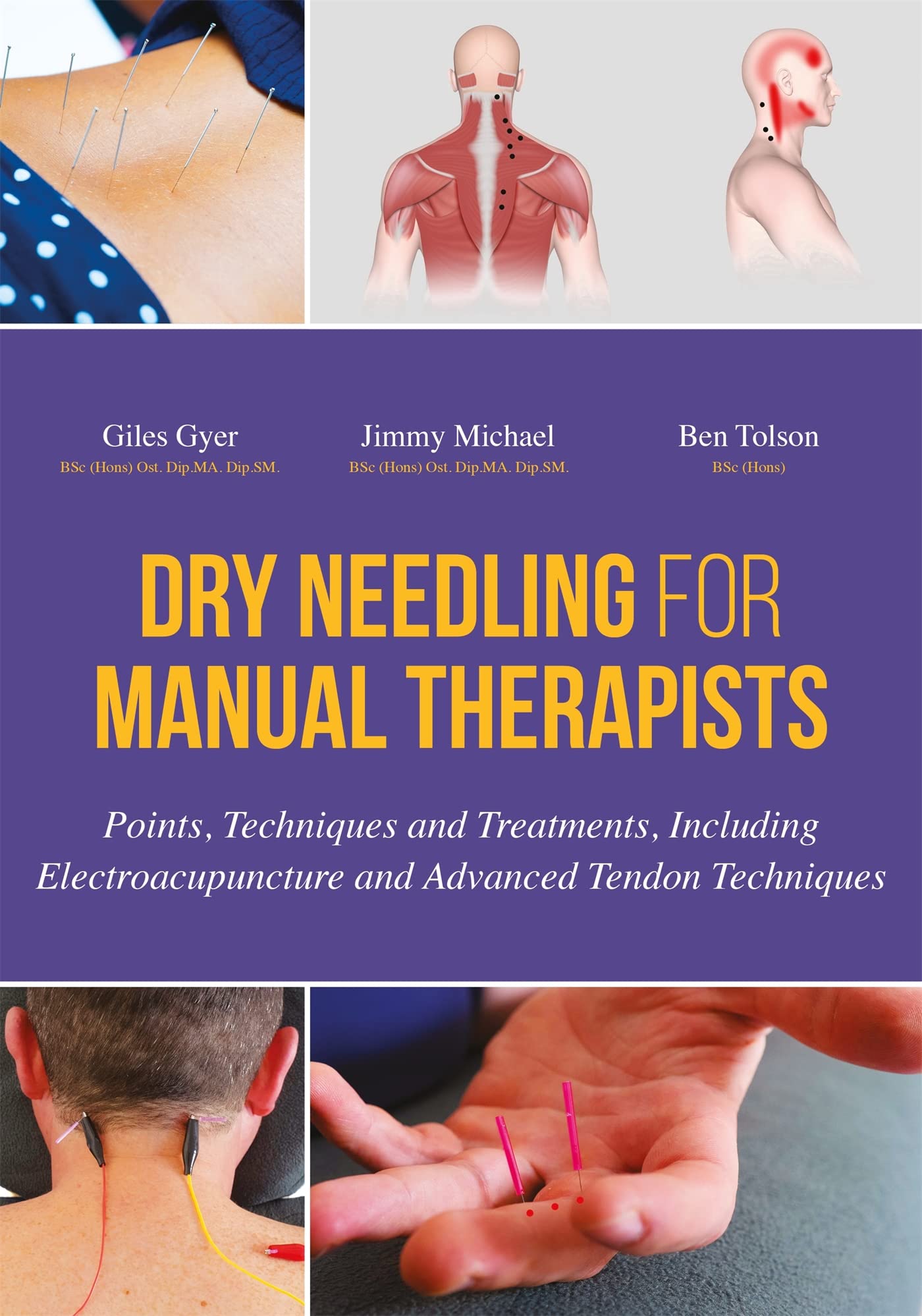 Dry Needling for Manual Therapists: Points, Techniques and Treatments, Including Electroacupuncture and Advanced Tendon Techniqu