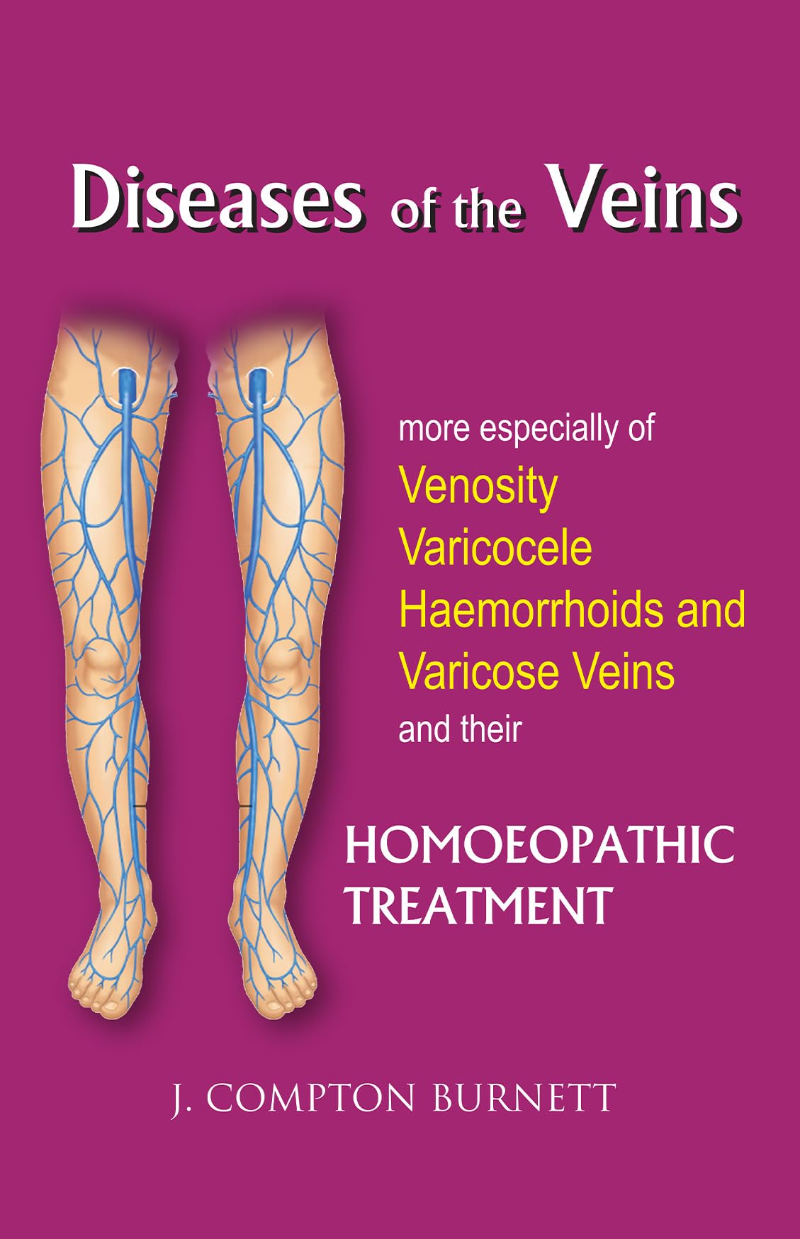 Diseases of the Veins  More Especilly of Venosity, Varicocele, Hemmorrhoids and Varicose Veins and their Homoeopathic Treatment