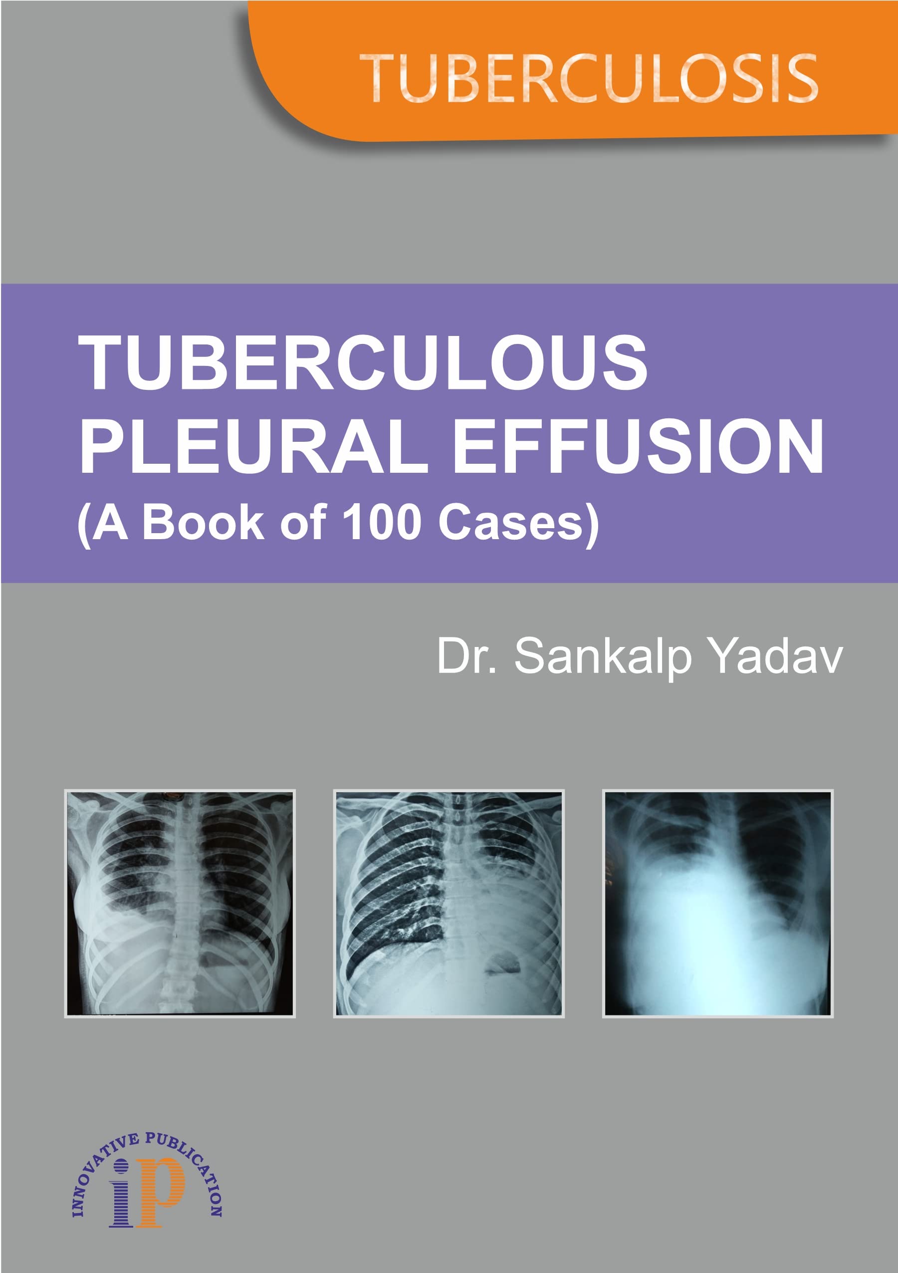 Tuberculous Pleural Effusion (A Book of 100 Cases)