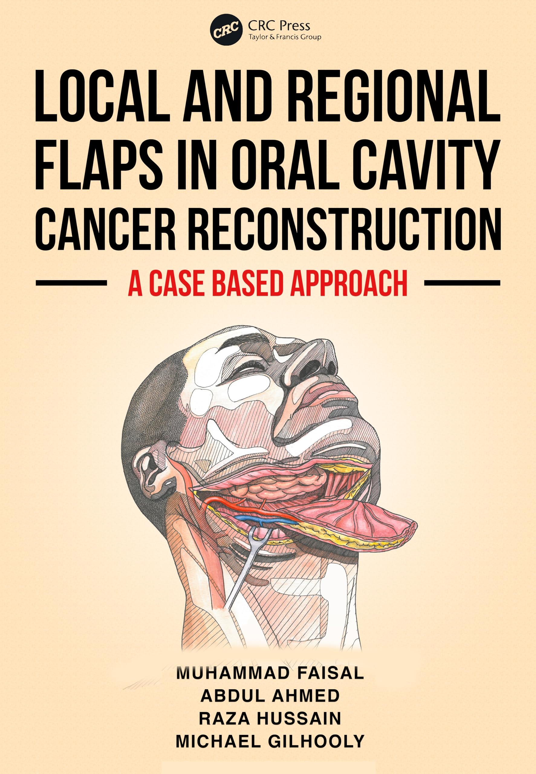 LOCAL AND REGIONAL FLAPS IN ORAL CAVITY CANCER RECONSTRUCTION A CASE BASED APPROACH (PB 2026)