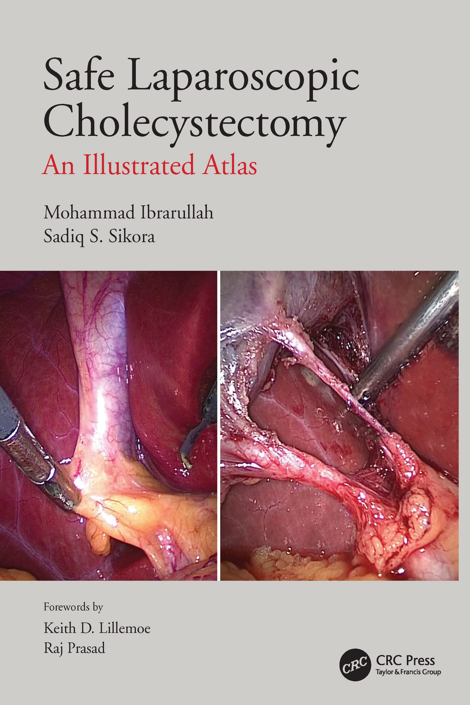 Safe Laparoscopic Cholecystectomy An Illustrated Atlas (Pb 2022)