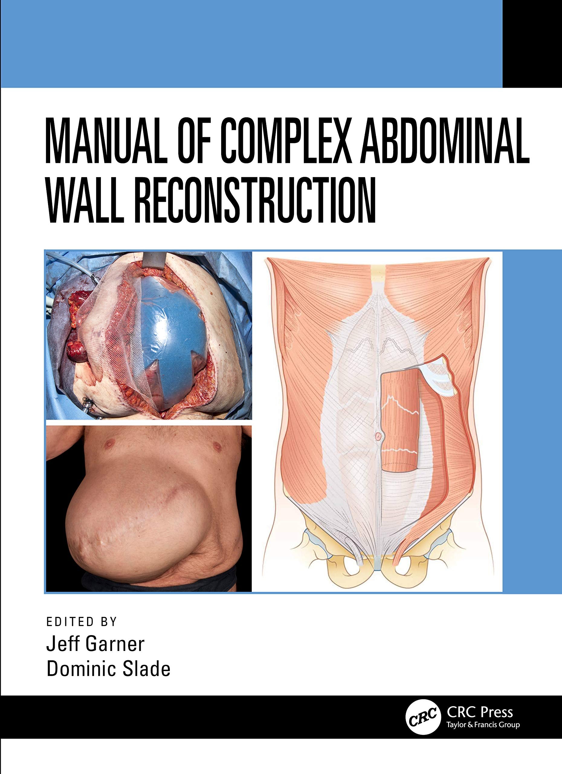 Manual Of Complex Abdominal Wall Reconstruction (Pb 2021)