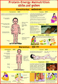 Protein Energy Malnutrition Chart ( Kwashiorkar & Marasmus )
