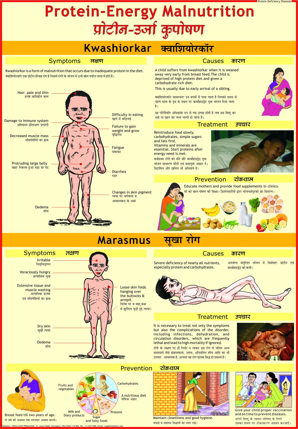 Protein Energy Malnutrition Chart ( Kwashiorkar & Marasmus )