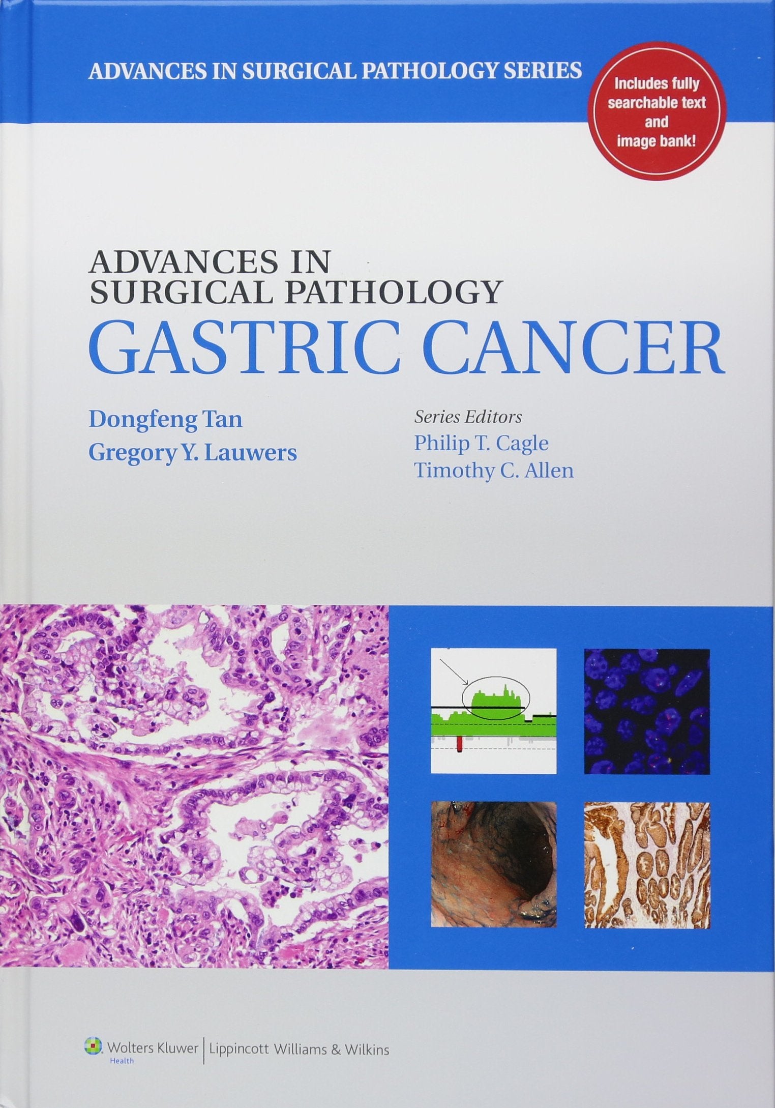 Advances In Surgical Pathology: Gastric Cancer