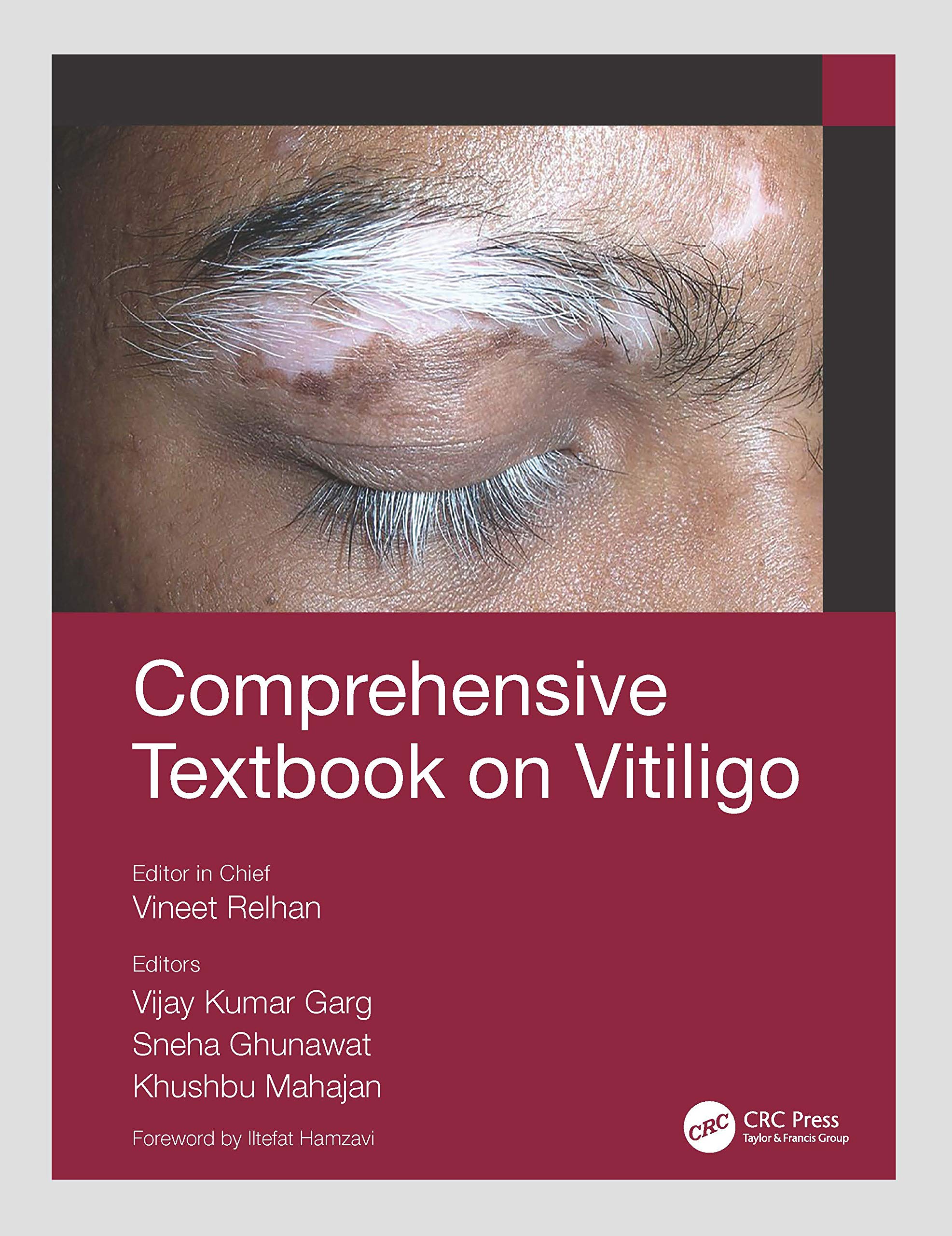 Comprehensive Textbook On Vitiligo (Pb 2022)